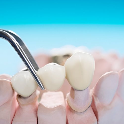 Dental Crowns rockville md