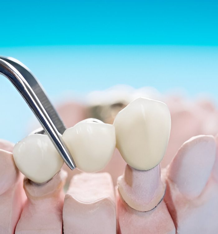 Dental Crowns rockville md