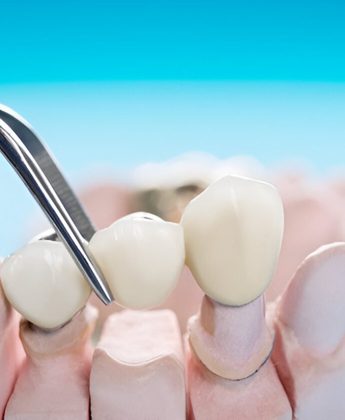 Dental Crowns rockville md