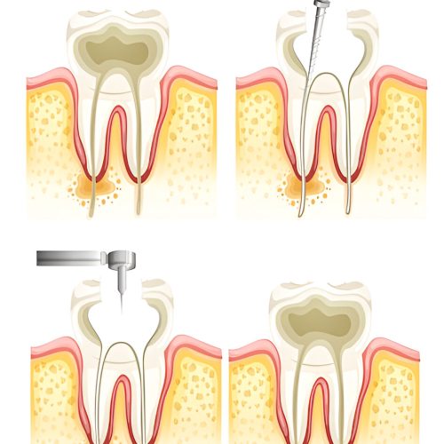 Root canal treatment rockville md