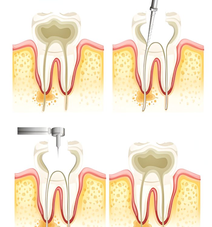 Root canal treatment rockville md