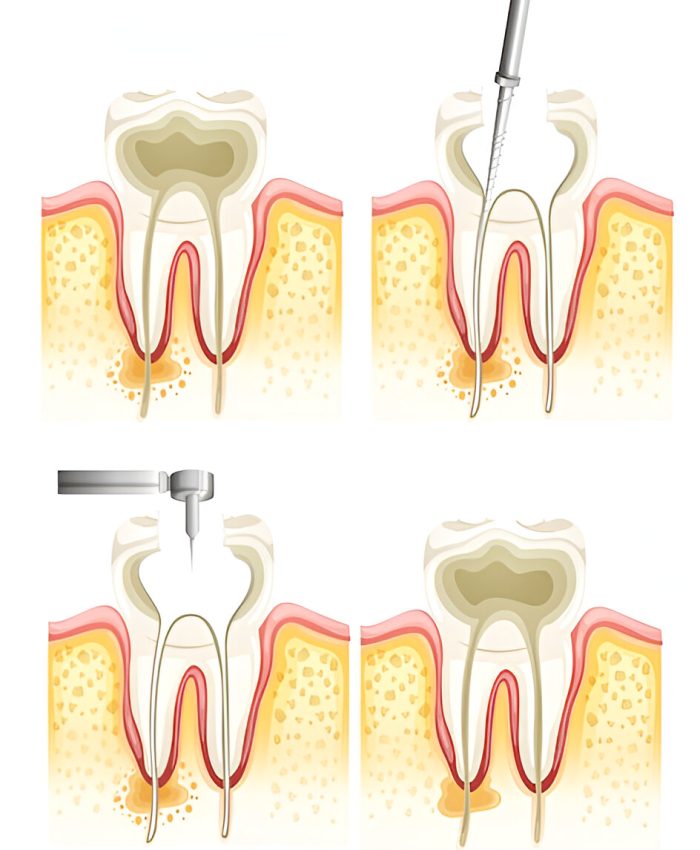 Root canal treatment rockville md