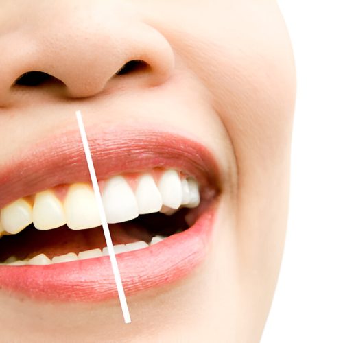 Teeth whitening near me rockville md