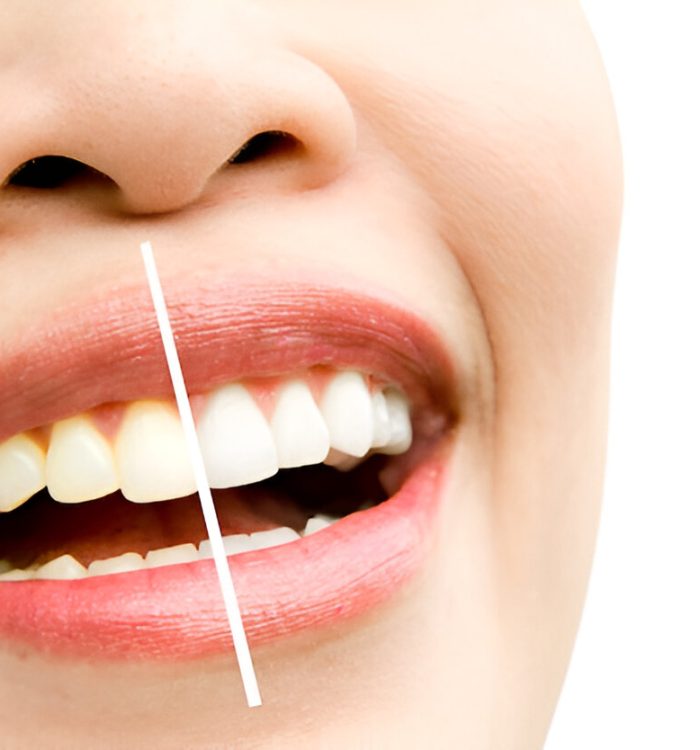 Teeth whitening near me rockville md
