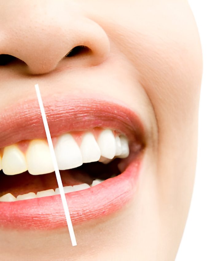 Teeth whitening near me rockville md